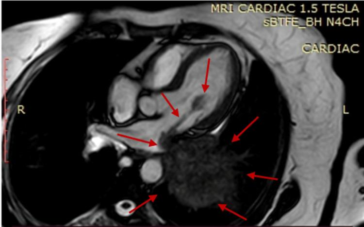 https://cdn.ncbi.nlm.nih.gov/pmc/blobs/f890/9481220/9f9af615ab04/cureus-0014-00000027859-i03.jpg