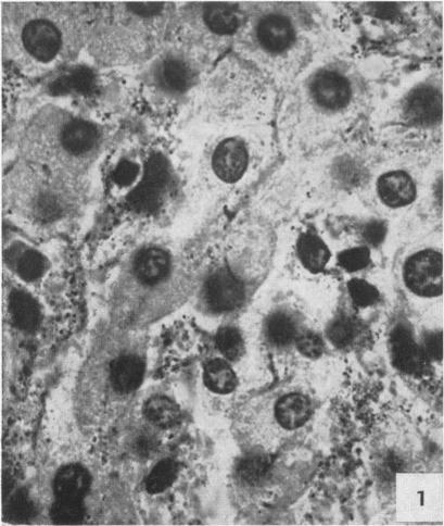 https://cdn.ncbi.nlm.nih.gov/pmc/blobs/f89c/1942923/49d20040d775/amjpathol00601-0269-a.jpg