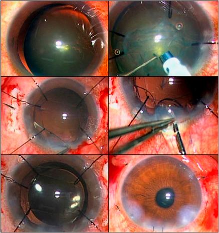 https://cdn.ncbi.nlm.nih.gov/pmc/blobs/f8b0/3259581/9b0072869537/eye2011242f1.jpg