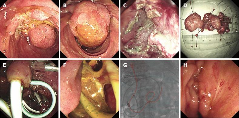 https://cdn.ncbi.nlm.nih.gov/pmc/blobs/f8d7/7701946/199958259d47/WJG-26-7036-g002.jpg