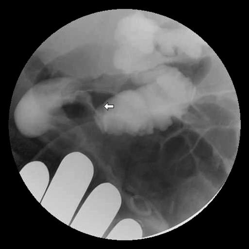 https://cdn.ncbi.nlm.nih.gov/pmc/blobs/f8d8/3030802/cfa48ff9ae05/jsls-13-4-612-g02.jpg