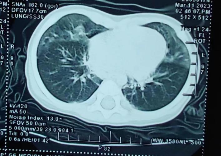 https://cdn.ncbi.nlm.nih.gov/pmc/blobs/f8de/11322232/04c00d03eba6/CRJ-18-e13827-g001.jpg