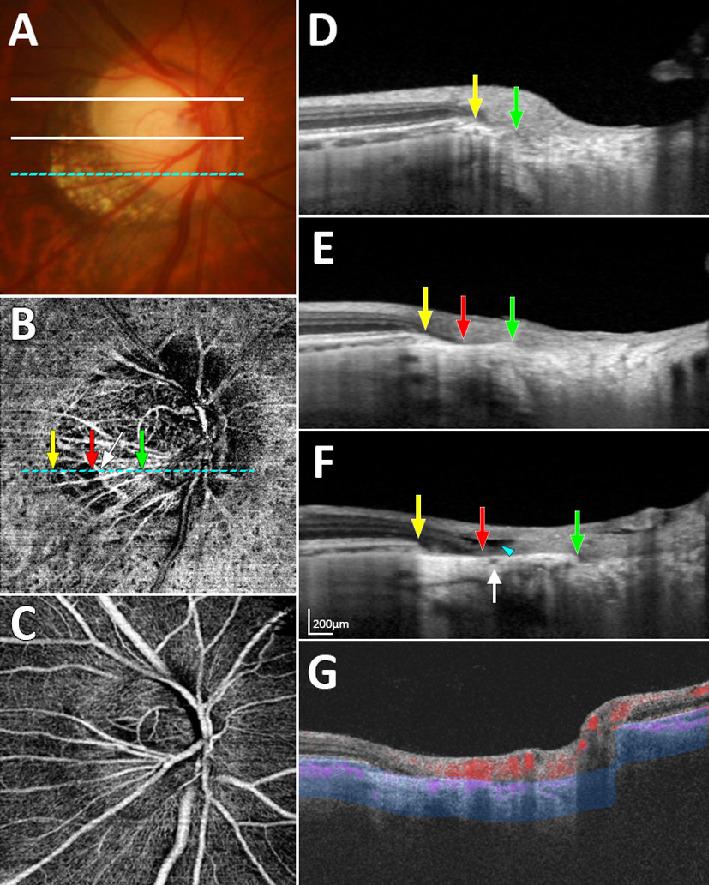 https://cdn.ncbi.nlm.nih.gov/pmc/blobs/f912/7329630/0aa847954bef/iovs-61-2-36-f005.jpg