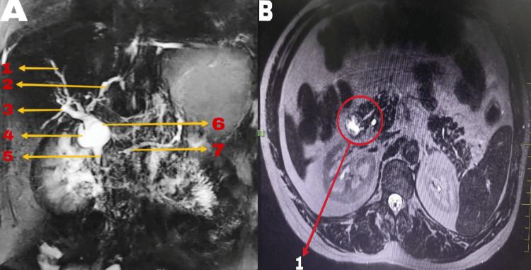 https://cdn.ncbi.nlm.nih.gov/pmc/blobs/f95a/11299473/113f79c10f3b/cureus-0016-00000063964-i01.jpg