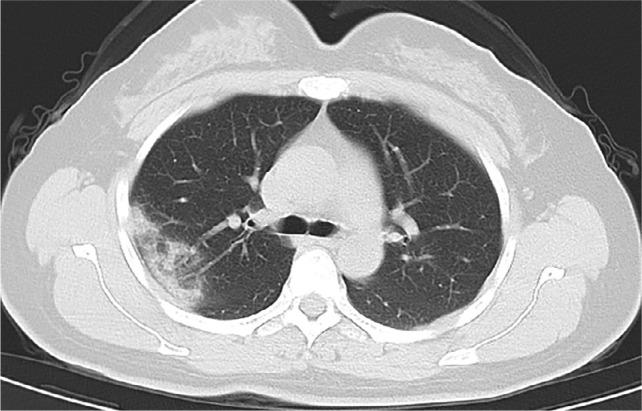 https://cdn.ncbi.nlm.nih.gov/pmc/blobs/f971/7233365/30e67eb64d74/radiol.2020200432.fig2d.jpg