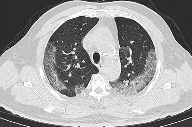https://cdn.ncbi.nlm.nih.gov/pmc/blobs/f971/7233365/89bbb396b9e8/radiol.2020200432.fig2a.jpg