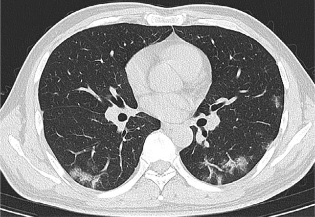 https://cdn.ncbi.nlm.nih.gov/pmc/blobs/f971/7233365/c089e39c8b5b/radiol.2020200432.fig2c.jpg