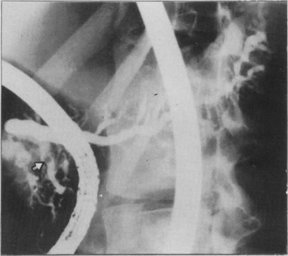 https://cdn.ncbi.nlm.nih.gov/pmc/blobs/f9ba/1432537/5dc61919825e/gut00395-0100-b.jpg