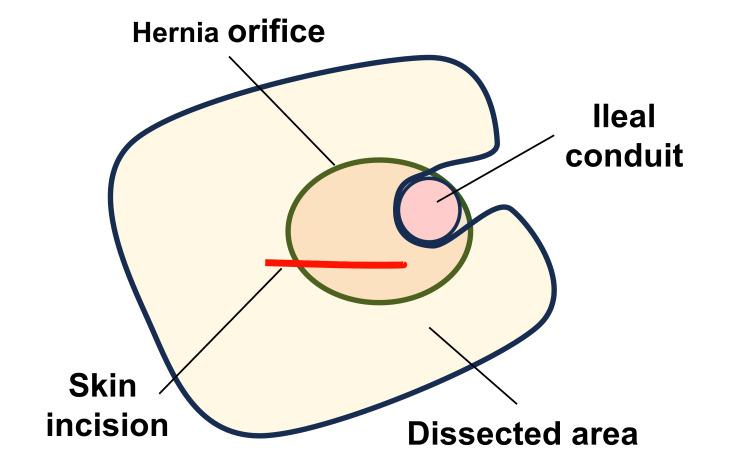 https://cdn.ncbi.nlm.nih.gov/pmc/blobs/f9de/12006874/4a0bae08c853/cureus-0017-00000082500-i05.jpg