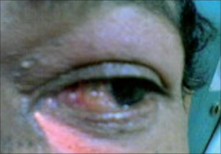 https://cdn.ncbi.nlm.nih.gov/pmc/blobs/fa3a/2636165/71c8f45fb3be/IndianJOphthalmol-56-325-g001.jpg