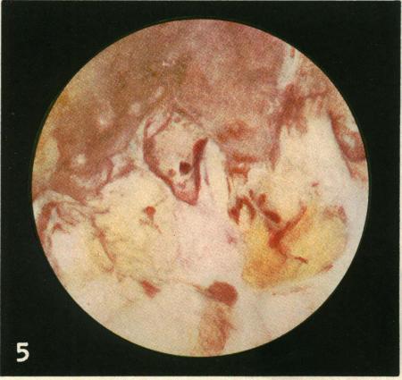 https://cdn.ncbi.nlm.nih.gov/pmc/blobs/fa62/1390483/0a59087143a2/annsurg00531-0143-e.jpg