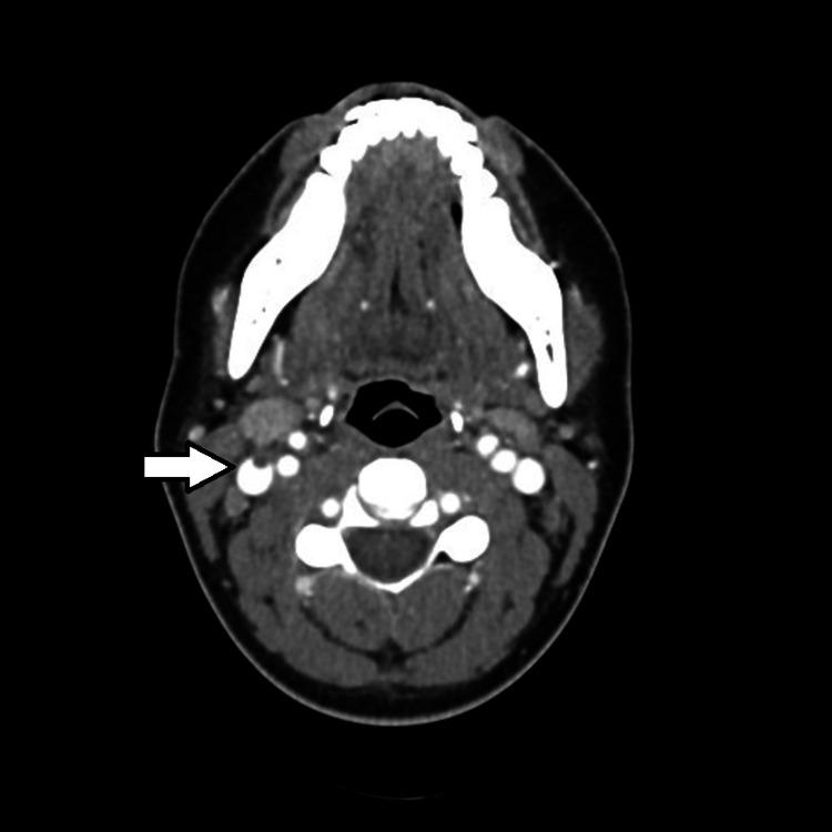 https://cdn.ncbi.nlm.nih.gov/pmc/blobs/fafe/8157818/5406328aac3a/cureus-0013-00000014713-i02.jpg