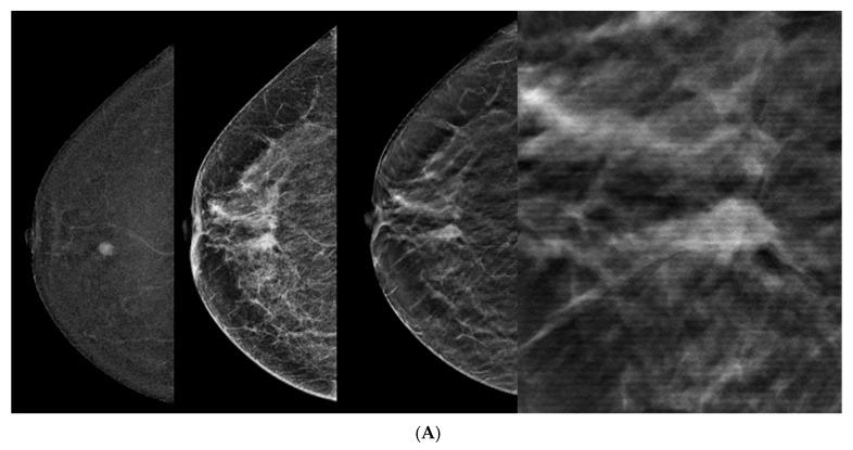 https://cdn.ncbi.nlm.nih.gov/pmc/blobs/fb05/11125662/277586fb0ae0/tomography-10-00061-g003a.jpg