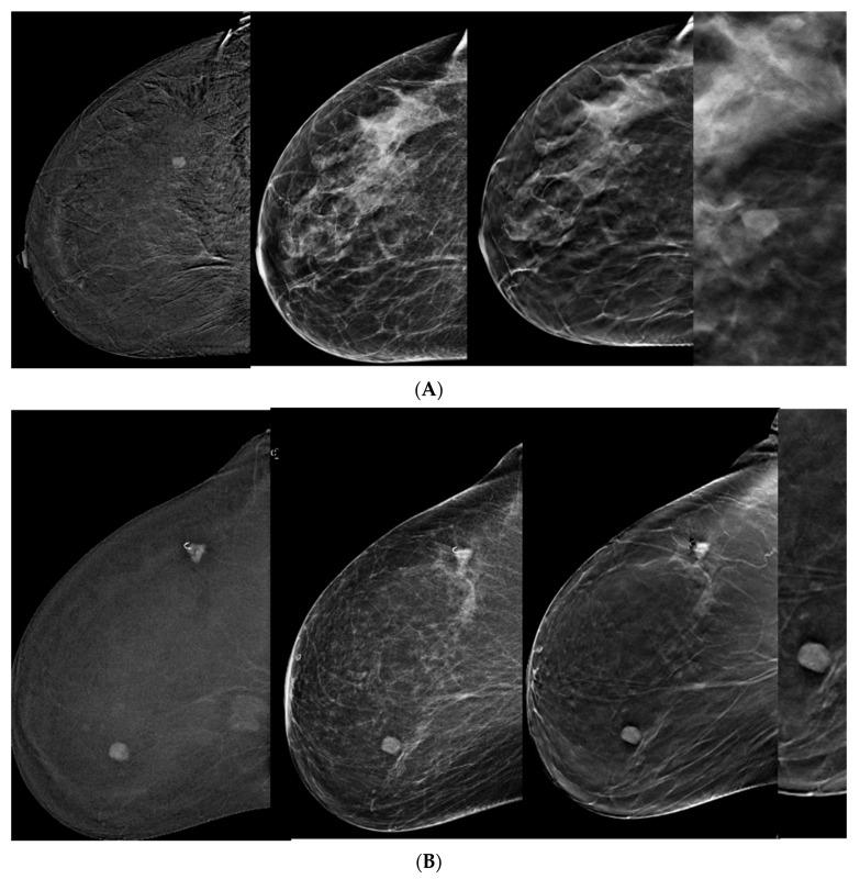 https://cdn.ncbi.nlm.nih.gov/pmc/blobs/fb05/11125662/6ed6f15d21b1/tomography-10-00061-g002a.jpg