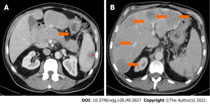 https://cdn.ncbi.nlm.nih.gov/pmc/blobs/fb6b/9639656/ba3569745234/WJG-28-5827-g007.jpg