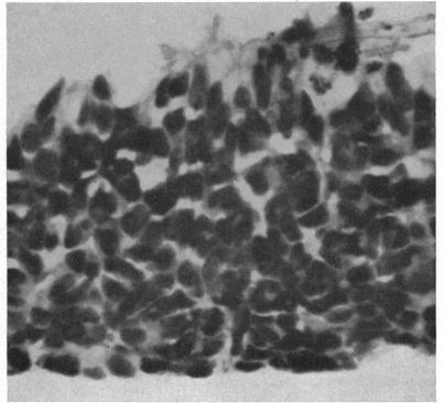 https://cdn.ncbi.nlm.nih.gov/pmc/blobs/fb6e/513741/2fe571d71638/brjopthal00433-0070-b.jpg