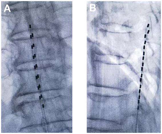 https://cdn.ncbi.nlm.nih.gov/pmc/blobs/fbb0/11997352/a97e8081cf1e/fneur-16-1551164-g002.jpg