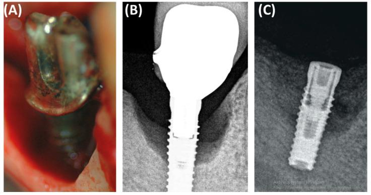 https://cdn.ncbi.nlm.nih.gov/pmc/blobs/fbc0/11354878/da3ad1deaf0e/jcm-13-04638-g005.jpg