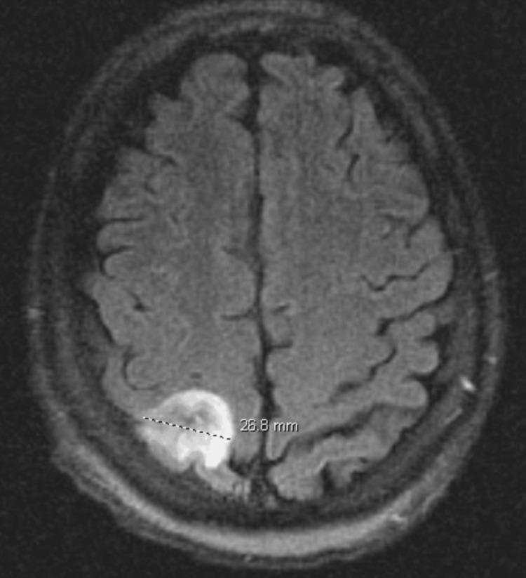 https://cdn.ncbi.nlm.nih.gov/pmc/blobs/fbd9/11233157/a7912a504b62/cureus-0016-00000062018-i02.jpg