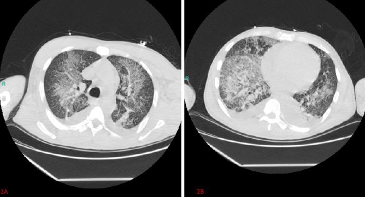 https://cdn.ncbi.nlm.nih.gov/pmc/blobs/fbd9/12239045/da1b90cb4eb0/cureus-0017-00000087582-i02.jpg