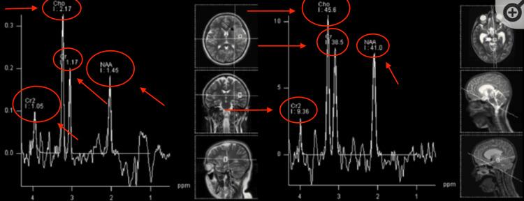 https://cdn.ncbi.nlm.nih.gov/pmc/blobs/fbe6/11379102/113e330f961f/cureus-0016-00000066390-i08.jpg