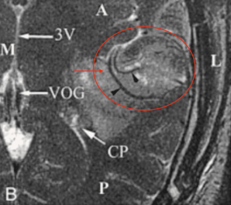 https://cdn.ncbi.nlm.nih.gov/pmc/blobs/fbe6/11379102/491e725c0520/cureus-0016-00000066390-i05.jpg