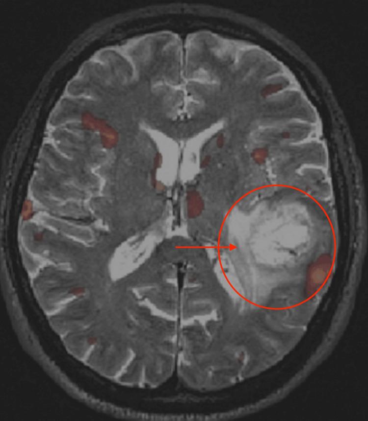 https://cdn.ncbi.nlm.nih.gov/pmc/blobs/fbe6/11379102/597e6825f50e/cureus-0016-00000066390-i03.jpg