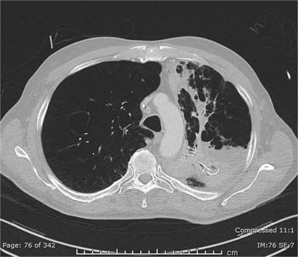 https://cdn.ncbi.nlm.nih.gov/pmc/blobs/fc46/5271380/01451cd9ec67/copd-12-383Fig5.jpg
