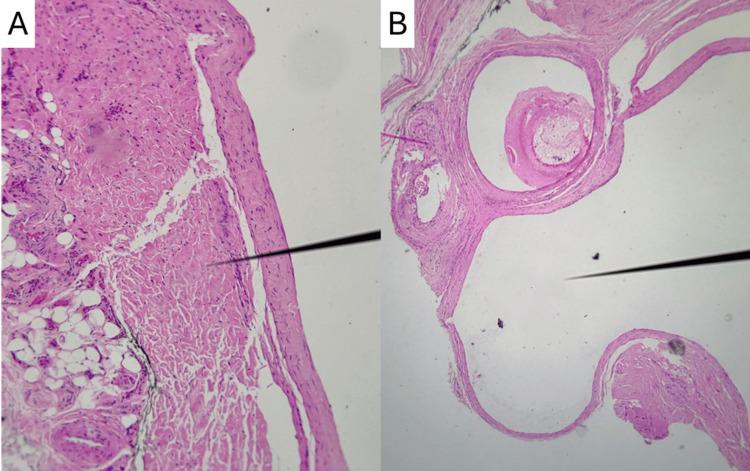 https://cdn.ncbi.nlm.nih.gov/pmc/blobs/fc9f/12352482/9782322ff019/cureus-0017-00000087993-i03.jpg