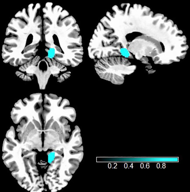 https://cdn.ncbi.nlm.nih.gov/pmc/blobs/fcca/12022757/6098d1d6fe41/fpsyt-16-1403604-g004.jpg