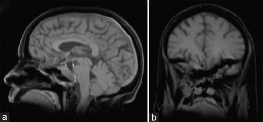 https://cdn.ncbi.nlm.nih.gov/pmc/blobs/fd47/6159024/d4a1c7d3712c/AJNS-13-888-g003.jpg