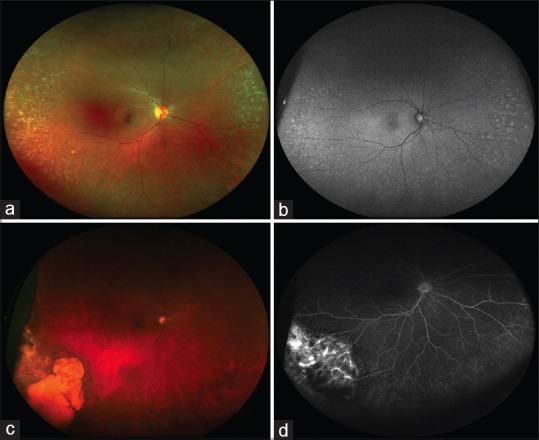 https://cdn.ncbi.nlm.nih.gov/pmc/blobs/fd77/8012972/582aee6e9bd1/IJO-69-824-g008.jpg