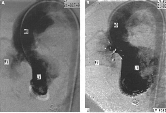 https://cdn.ncbi.nlm.nih.gov/pmc/blobs/fd8c/1025549/0b825eddba09/brheartj00007-0062-a.jpg