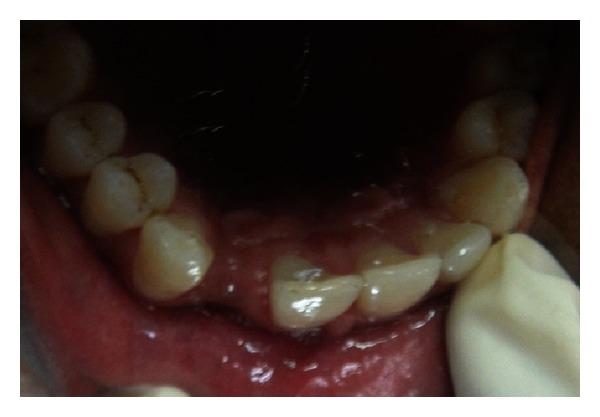 https://cdn.ncbi.nlm.nih.gov/pmc/blobs/fe27/3674654/4ef7b5ce888d/CRIM.DENTISTRY2013-748405.002.jpg