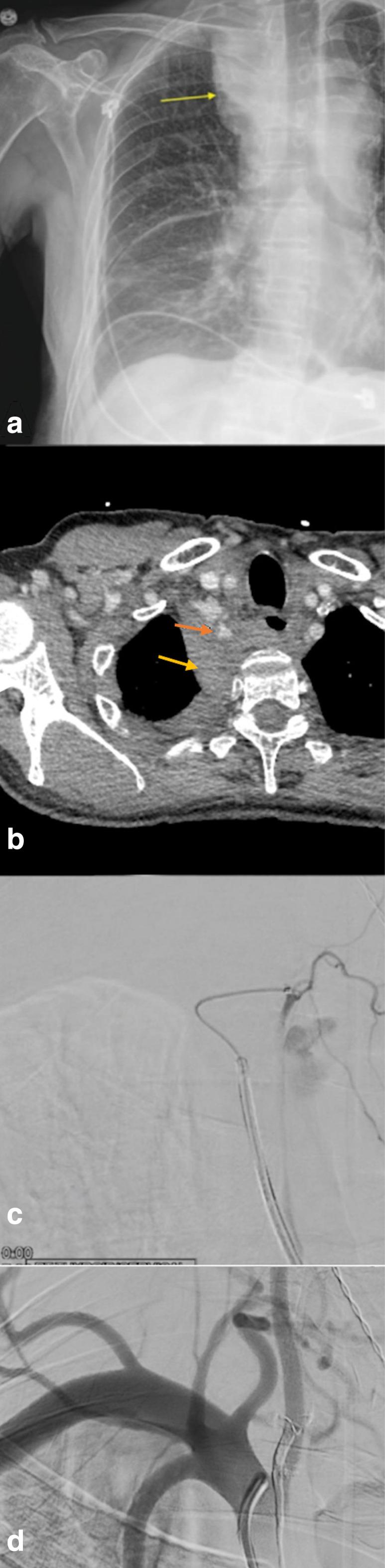 https://cdn.ncbi.nlm.nih.gov/pmc/blobs/fe48/10230224/6cdf6cc96a8a/bjrcr.20220136.g002.jpg