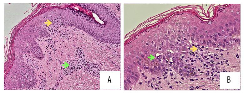 https://cdn.ncbi.nlm.nih.gov/pmc/blobs/fe54/11725661/31c714e70db7/amjcaserep-26-e945897-g004.jpg