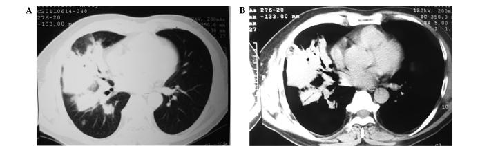 https://cdn.ncbi.nlm.nih.gov/pmc/blobs/fee7/5103774/b225f42db322/etm-12-05-3256-g01.jpg
