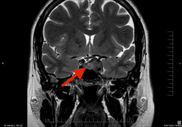 https://cdn.ncbi.nlm.nih.gov/pmc/blobs/ff63/12242357/029c86f61951/cureus-0017-00000085675-i01.jpg
