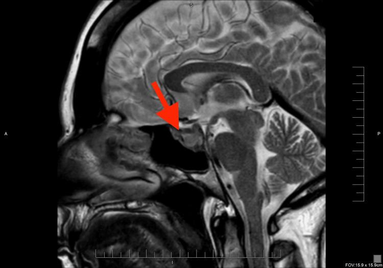 https://cdn.ncbi.nlm.nih.gov/pmc/blobs/ff63/12242357/59b61da754ab/cureus-0017-00000085675-i02.jpg