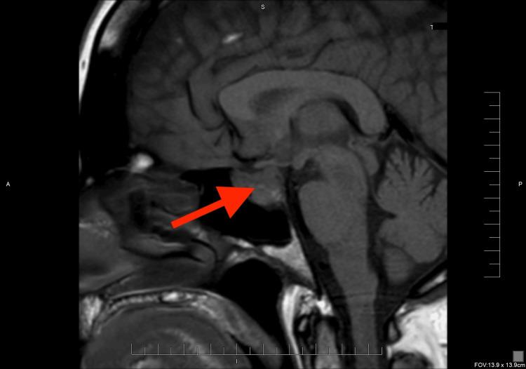 https://cdn.ncbi.nlm.nih.gov/pmc/blobs/ff63/12242357/c0201662833c/cureus-0017-00000085675-i03.jpg