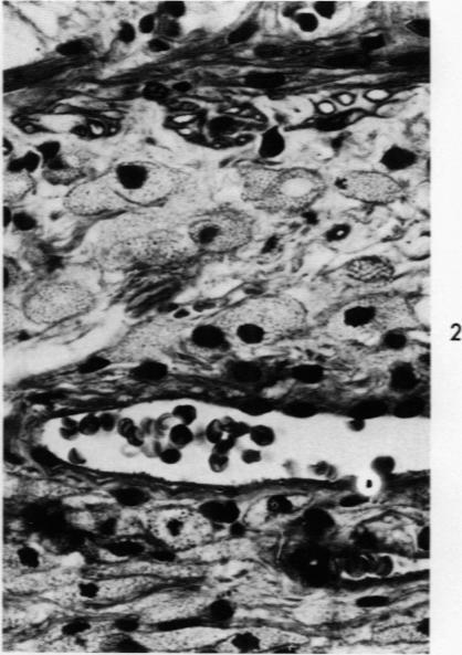 https://cdn.ncbi.nlm.nih.gov/pmc/blobs/ff96/1915033/9189b044125f/amjpathol00464-0147-b.jpg
