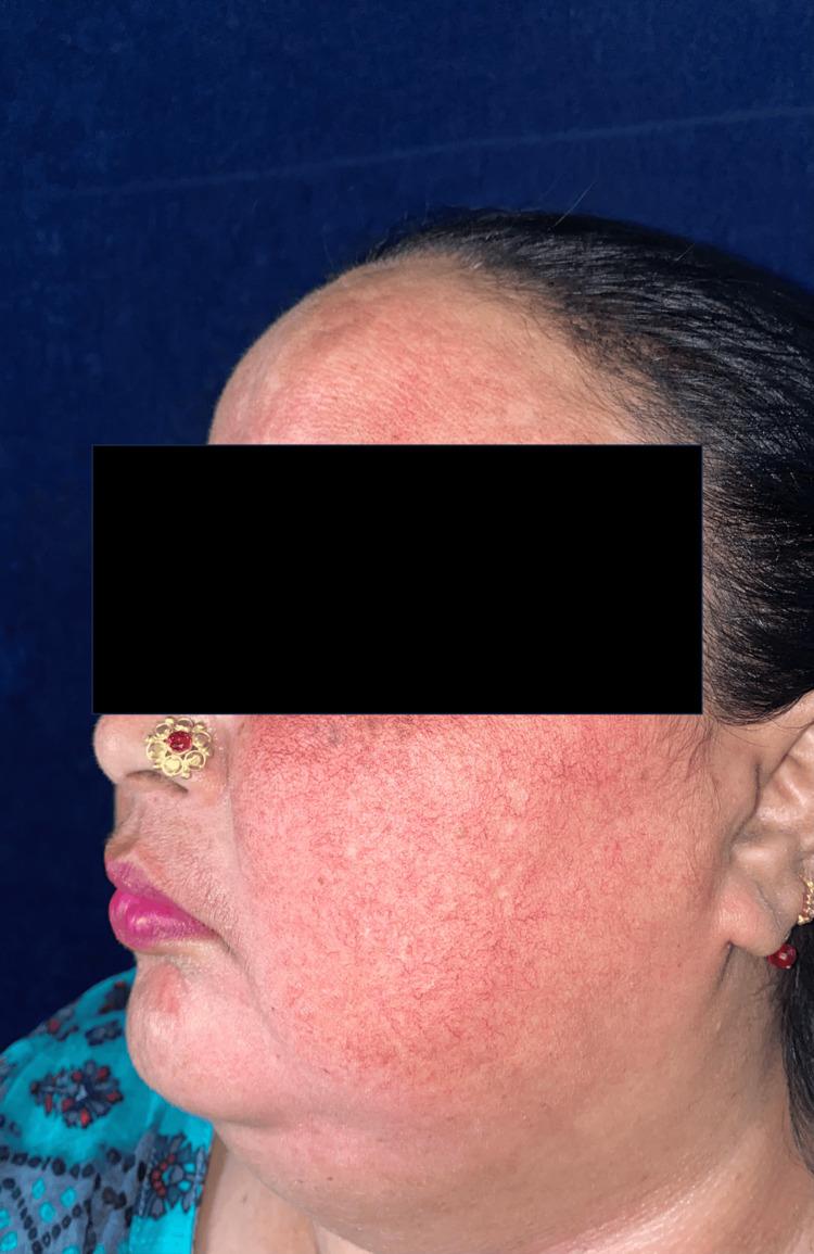 https://cdn.ncbi.nlm.nih.gov/pmc/blobs/ffb6/11680711/176b8865554b/cureus-0016-00000074624-i02.jpg