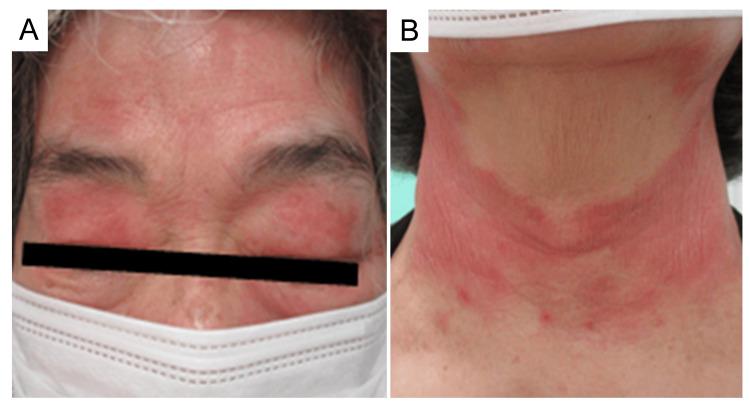 https://cdn.ncbi.nlm.nih.gov/pmc/blobs/ffd5/11717388/33caf43af9f2/cureus-0016-00000075441-i02.jpg