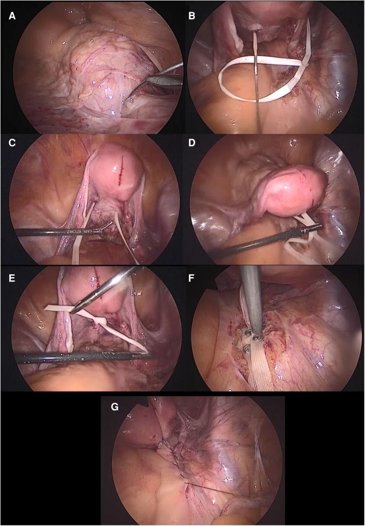 https://cdn.ncbi.nlm.nih.gov/pmc/blobs/fffb/10349534/5635f2509a91/fsurg-10-1222950-g001.jpg