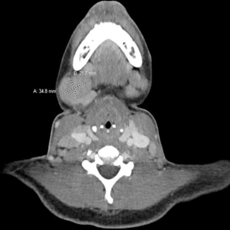 https://cdn.ncbi.nlm.nih.gov/pmc/blobs/fffe/8336297/6317e5d503d4/cureus-0013-00000016163-i01.jpg